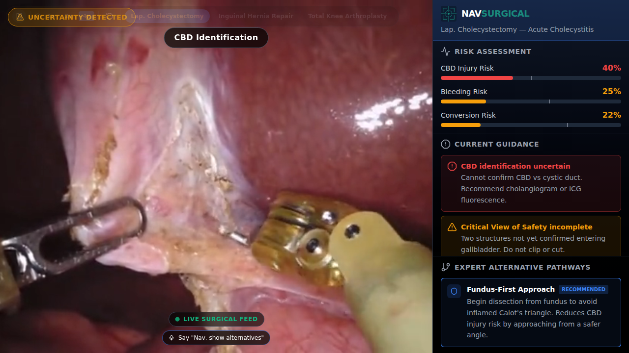 NAVSurgical interface showing real-time risk assessment, surgical guidance, and expert alternative pathways during a laparoscopic cholecystectomy